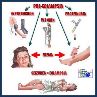 A Few Facts About Pre-Eclampsia