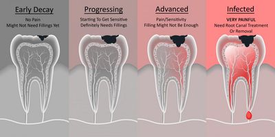 Dental Issues That Cause Wisdom Tooth Pain