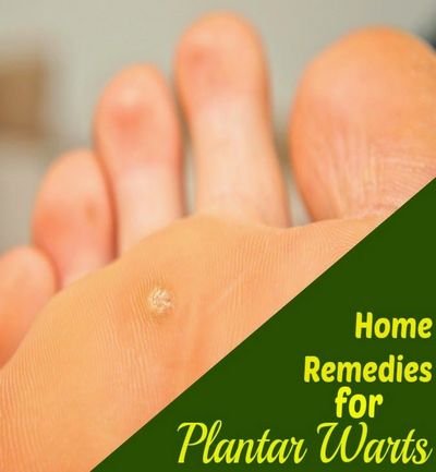 Effective Natural Remedies For Plantar Wart