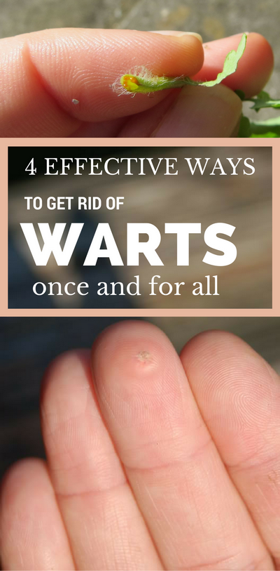 Effective Natural Remedies For Plantar Wart
