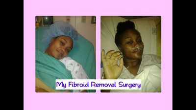 Fibroids Surgery - How to Remove Fibroids From the Body