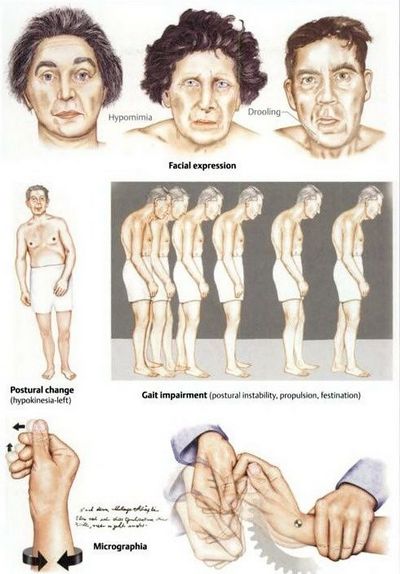 How to Identify and Treat Parkinson's Symptoms