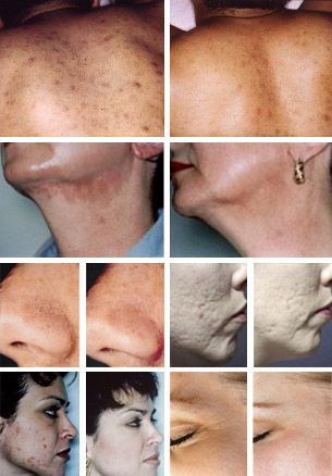 Learn About Microdermabrading - The Pros and Cons