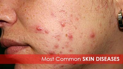 Learn About the Most Common Skin Diseases