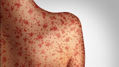 Measles Symptoms and How to Recognize Them