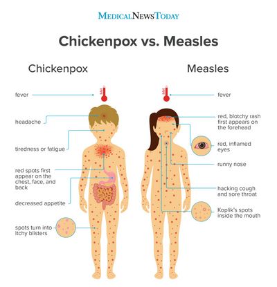 Measles Symptoms and How to Recognize Them