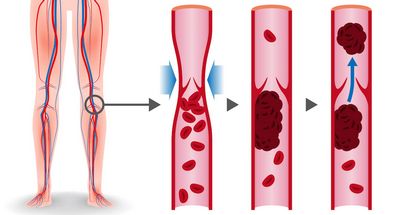 Thrombophlebitis - What Is Thrombophlebitis and How Is It Treated?