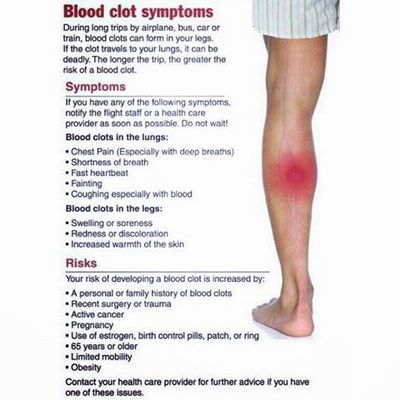 Thrombophlebitis - What Is Thrombophlebitis and How Is It Treated?