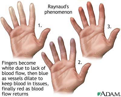 Treating Raynaud's Disorder