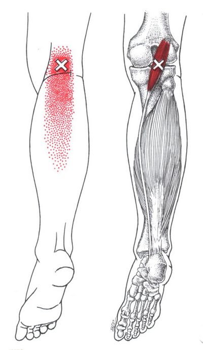 Treatment of Myofascial Pain