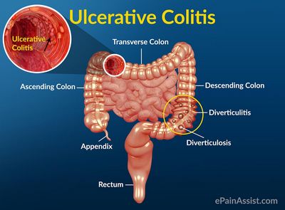 Ulcer-Colitis Treatment