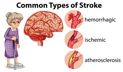 What Are The Different Types of Strokes?
