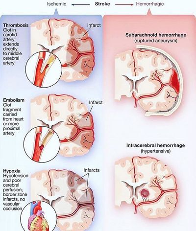 What Are The Different Types of Strokes?