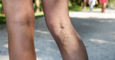 What Does Blood Clot In A Leg Mean?