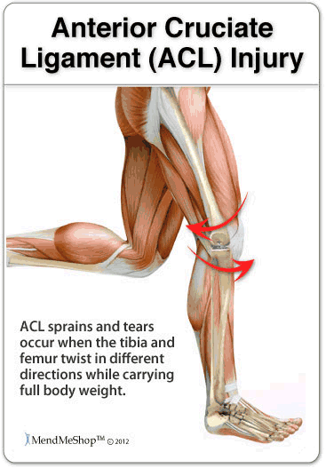 What Happens When Your Knee Is Sprained?