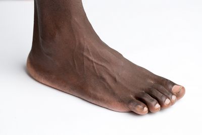 Which Type of Flat Foot Treatment Is Right For You?