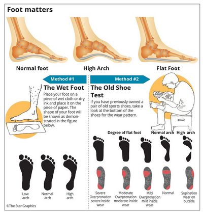 Which Type of Flat Foot Treatment Is Right For You?
