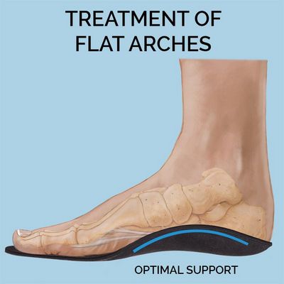 Which Type of Flat Foot Treatment Is Right For You?